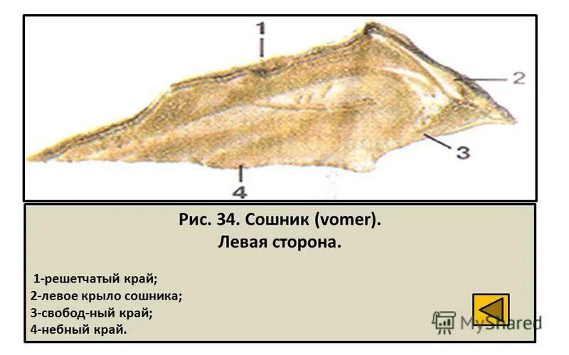 Сошник кость. Сошник анатомия строение. Vomer сошник. Кость сошник у человека. Сошник топография.