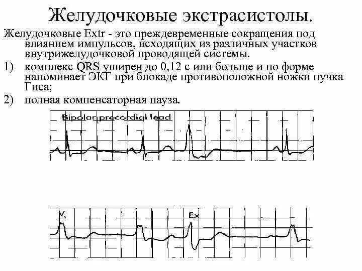 Сколько экстрасистол норма