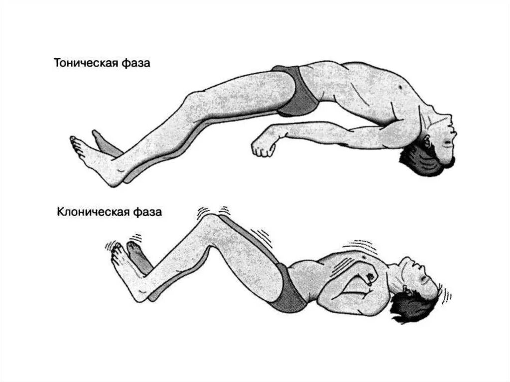 Тонико-клонические припадки. Тонико-клонические судороги. Эпилепсия тонико-клонические судороги. Фазы эпилептического припадка. Эпилептический удар