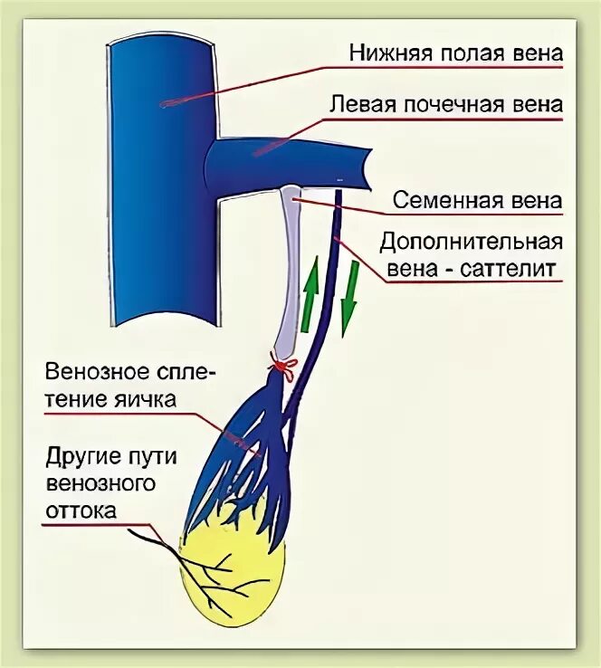 Семенные вены анатомия. Внутренняя семенная Вена. Варикоцеле анатомия вены. Расширение вены семенного канатика