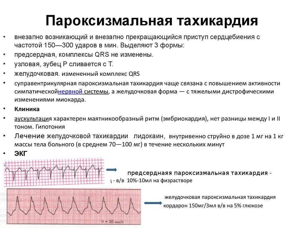 ЭКГ – критерии пароксизма наджелудочковой тахикардии.. Пароксизмальная тахикардия ЭКГ признаки. ЭКГ изменения при пароксизмальной тахикардии. Пароксизм синусовой тахикардии на ЭКГ. Признаки тахикардия у женщины симптомы