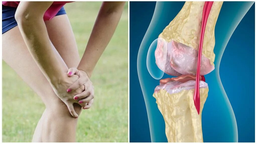 пателлофеморальный артроз коленного сустава что это такое. пателло-феморального артроз это. пателлофеморальный артроз коленного. хондромаляция суставного хряща степени. пателлофеморальное сочленение коленного.