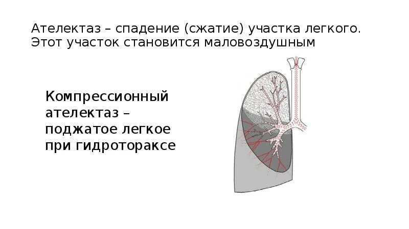 Обтурационный ателектаз легкого. Компрессионный ателектаз лёгкого. Аспирационный ателектаз легкого. Компрессионный ателектаз при гидротораксе. Сегментарный ателектаз.