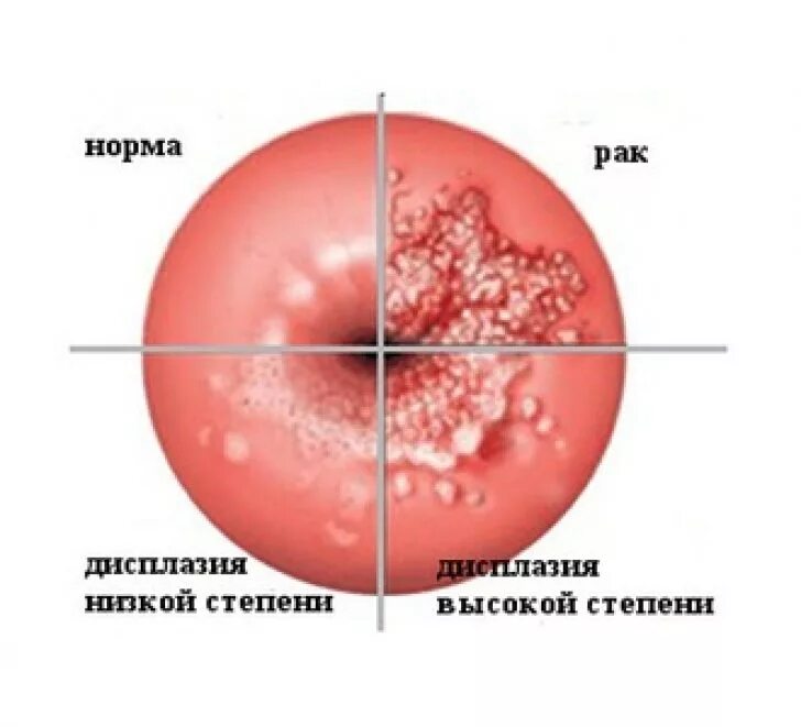 Эритроциты в цервикальном канале