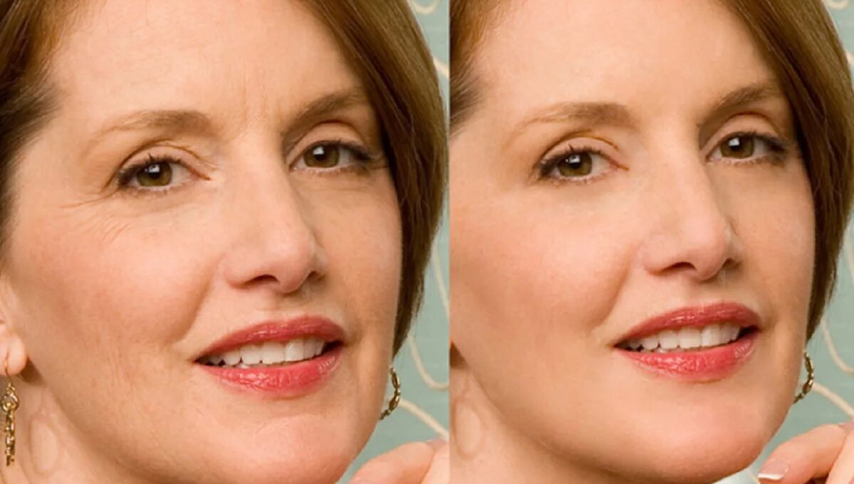 Плазмолифтинг отзывы фото до и после лицо. Плазмолифтинг для лица фото. Плазмолифтинг лица до и после. Плазмолифтинг до и после фото. Плазмолифтинг для лица до и после фото.