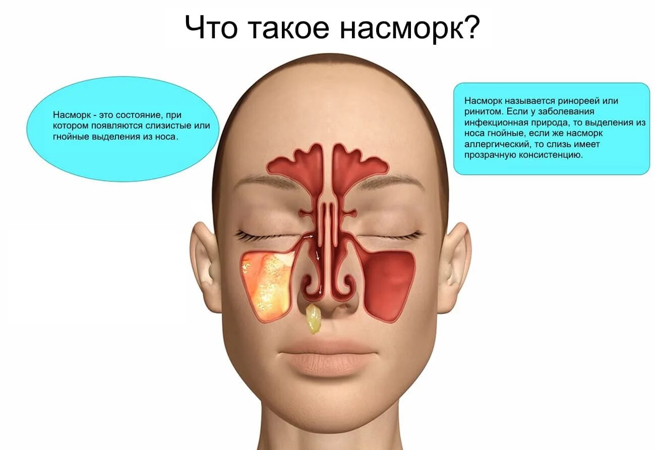 Болит переносица при нажатии насморка