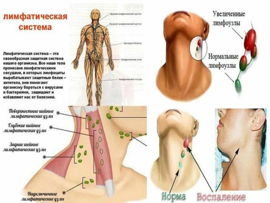 Лимфоузлы и мышцы. Воспаление лимфатические узлы шеи причины. Воспалились шейные лимфоузлы причины. Строение лимфатических узлов на шее. Поверхностные шейные лимфатические узлы располагаются.