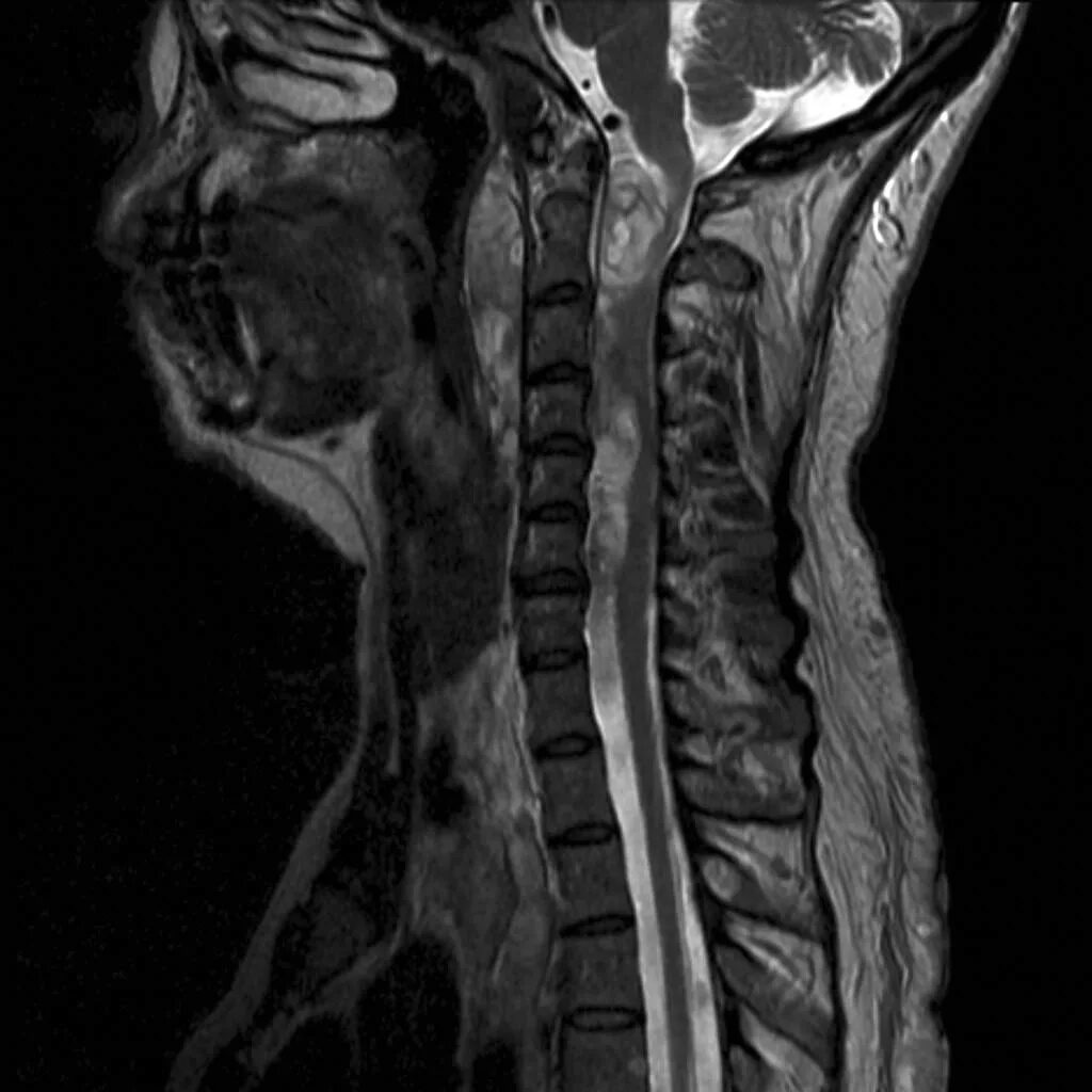 Spine mri