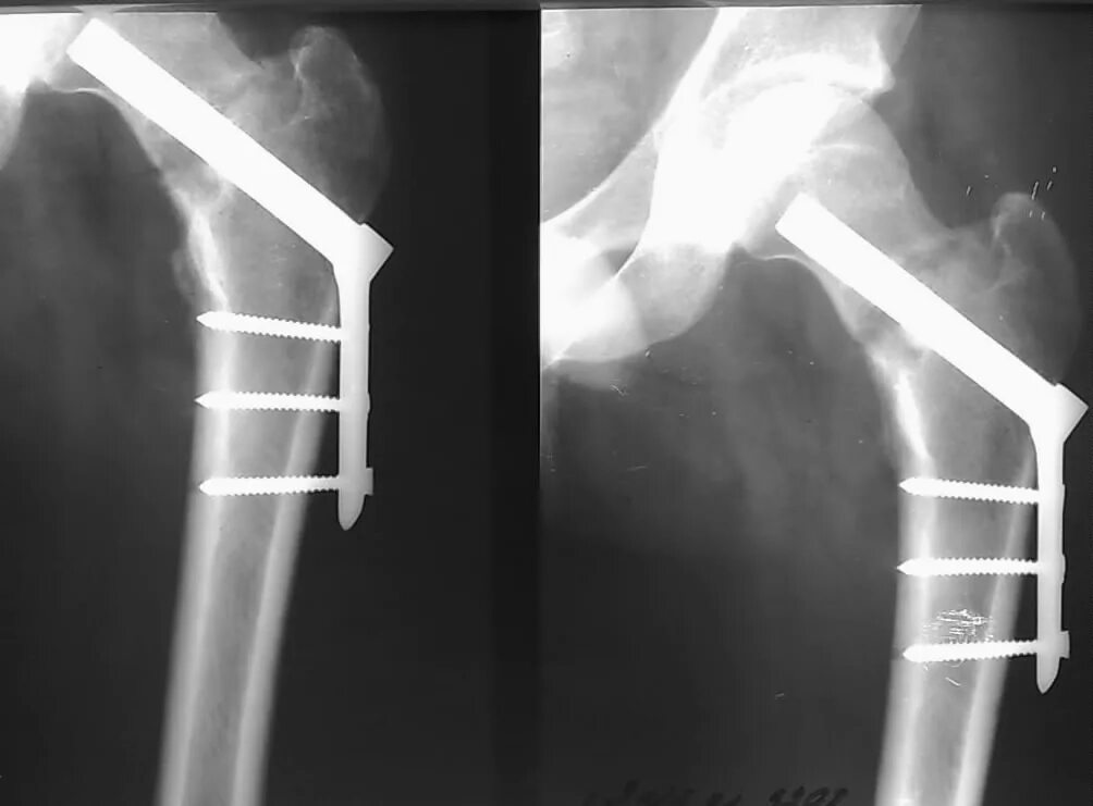 Шейка бедра видео. Перелом шейки бедра гипсуют. Переломы шейки бедра трехлопастной гвоздь. Перелом шейки бедра гипс. Перелом шейки бедра сапожок.