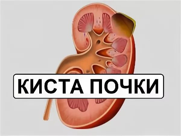 Киста почек народные средства. Лекарство от кисты почек. Киста на почке лечение народными средствами.