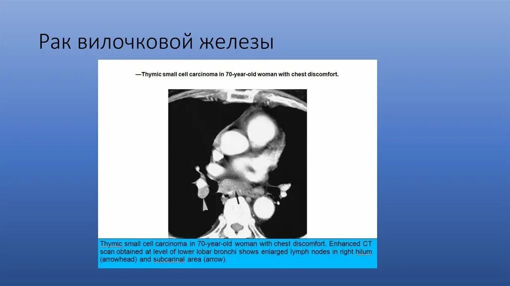 Доброкачественные опухоли вилочковой железы. Злокачественная тимома. Новообразования вилочковой железы. Опухоль вилочковой железы у взрослых. Онкология вилочковой железы.