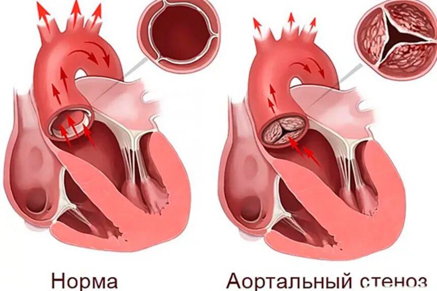 Аортальные пороки сердца. Кальциноз аортального клапана.