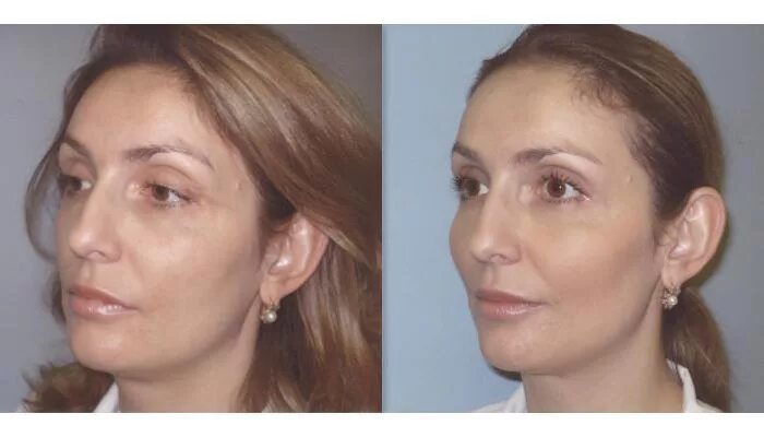 Скулы до и после. Контурная пластика скул до и после. Пластика скул до и после. Контурная пластика скул до и после. Скулы до и после.