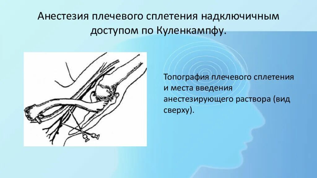 Блокада сплетения. Межлестничная блокада плечевого сплетения. Анестезия плечевого сплетения. Анестезия плечевого сплетения по Куленкампфу. Проводниковая анестезия плечевого сплетения.