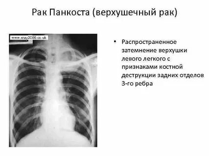 Рак панкоста