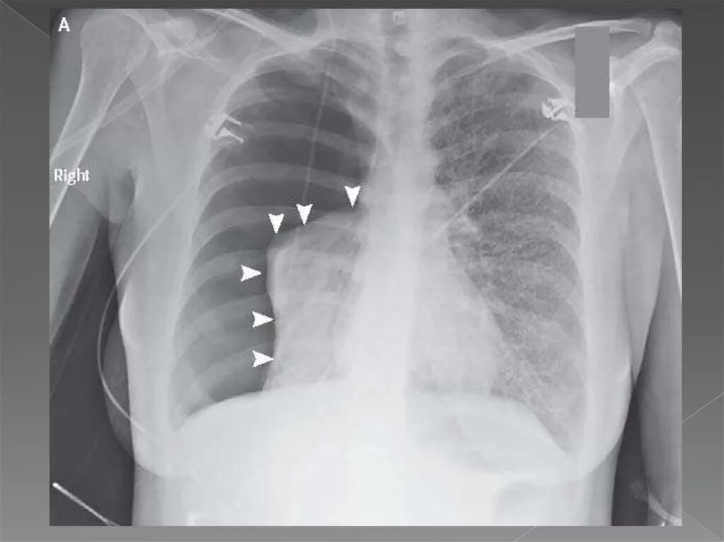 Разрыв легочной. Пневмоторакс рентген. Спонтанный пневмоторакс рентгенограмма. Открытый пневмоторакс рентген. Открытый спонтанный пневмоторакс рентген.