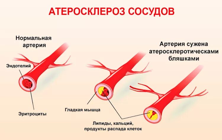 Атеросклероз церебральных сосудов симптомы. Атеросклероз сосудов головного мозга. Заболевание церебральный атеросклероз. Признаки атеросклероза сосудов.