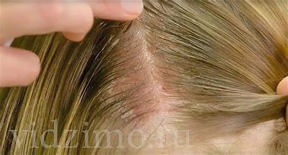 Чешется голова выпадают волосы чем лечить