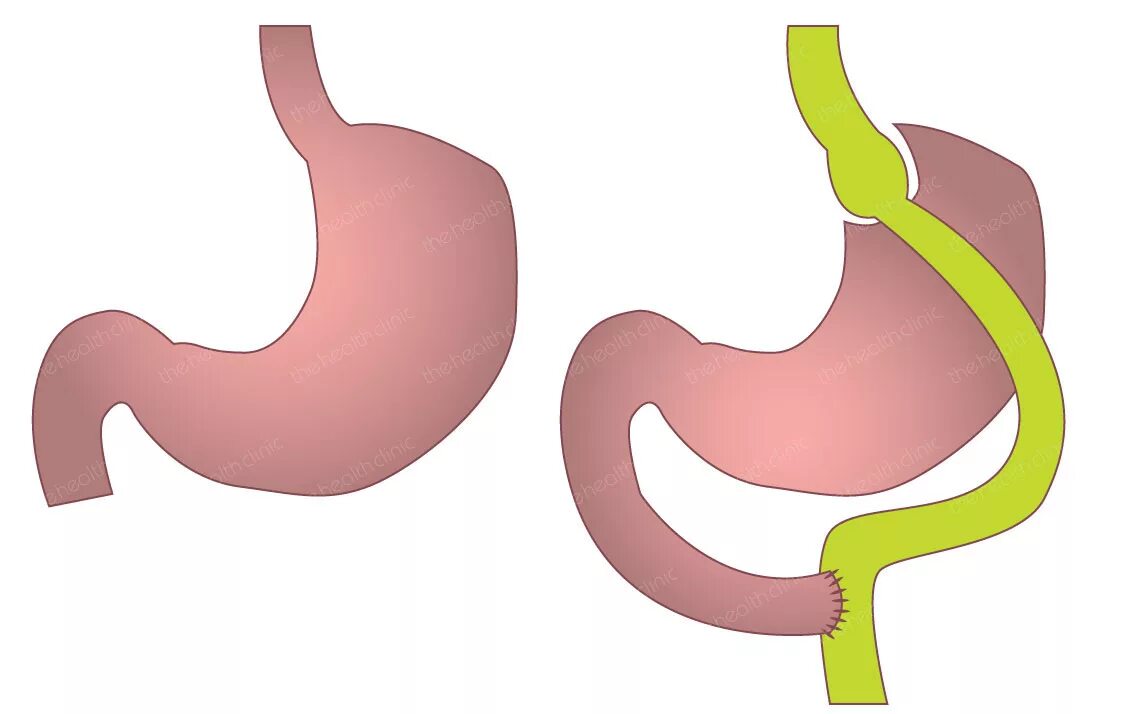 Желудочное шунтирование (gastric Bypass). Желудочного шунтирования Roux-en-y.. Лапароскопическое гастрошунтирование. Шунтирование бандажирование резекция желудка.