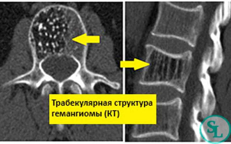 Гемангиома в теле позвоночника th3 позвонка. Эпидуральный абсцесс позвоночника мрт. Ангиома позвоночника. Вертебропластика гемангиомы позвонка. Серпигинозная ангиома.