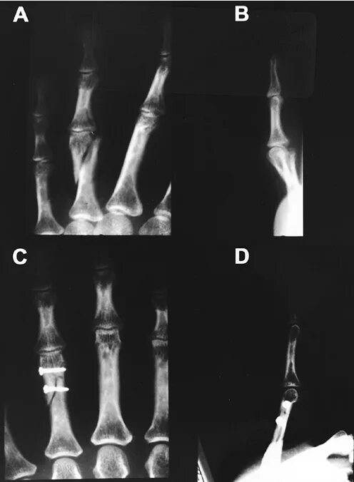 Трещина фаланги. Остеосинтез фаланги пальца. Остеосинтез фаланги пальца стопы. Оскольчатый перелом фаланги пальца руки. Перелом фаланги мизинца рентгенограмма.