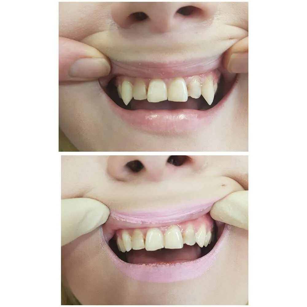 Можно ли точить зубы. Можно ли точить зубы. Можно ли точить зубы. Человек с острымиубами. Лингвальные керамические брекеты.