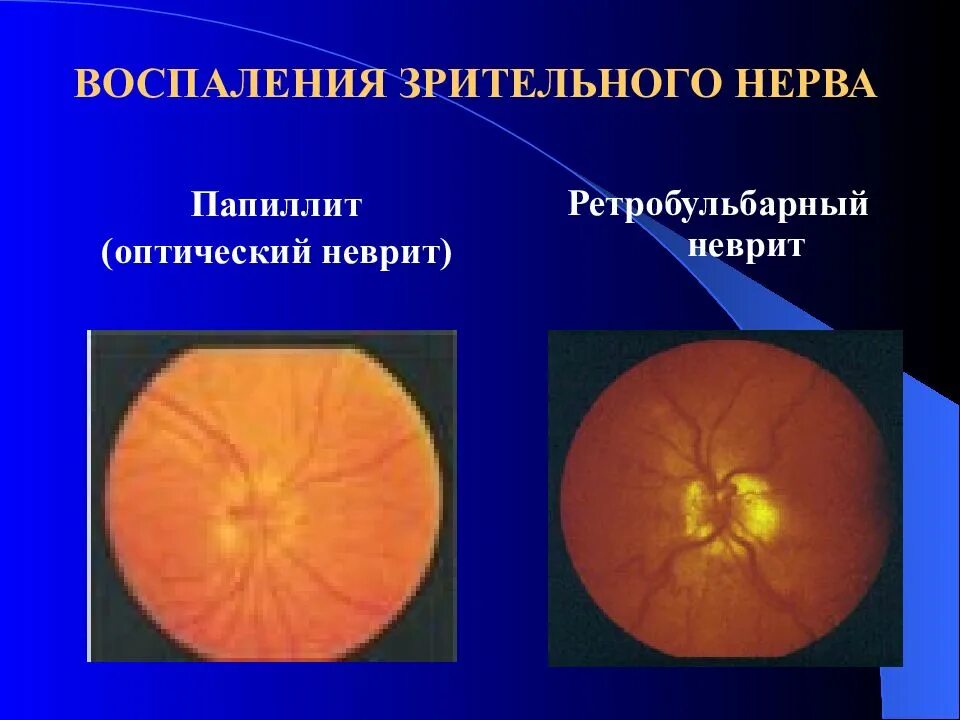 Тип зрительного нерва. Оптический неврит папиллит. Ретробульбарный неврит (папиллит). Папиллит диска зрительного нерва. Ретробульбарный неврит зрительного нерва.