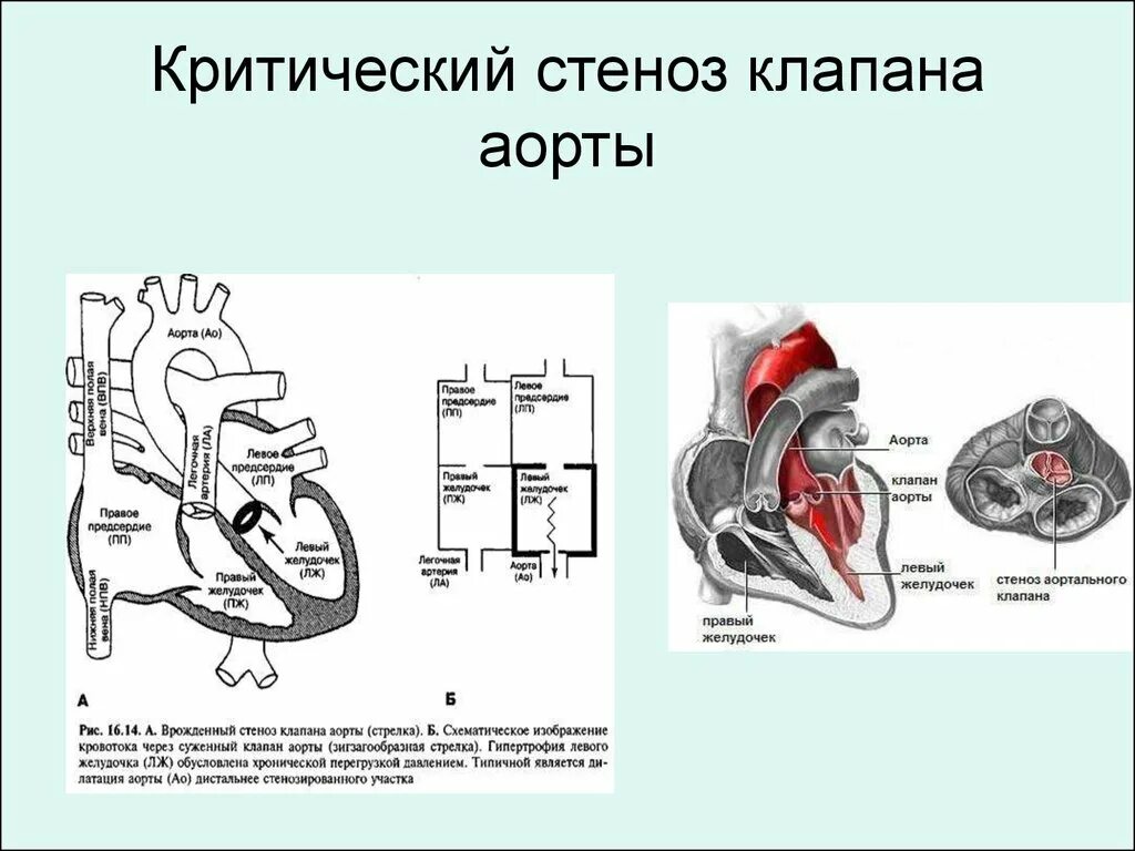 Аортальный стеноз что это такое. ВПС стеноз аортального клапана. Клапанный, надклапанный и подклапанный стеноз аорты. Критический стеноз аортального клапана.