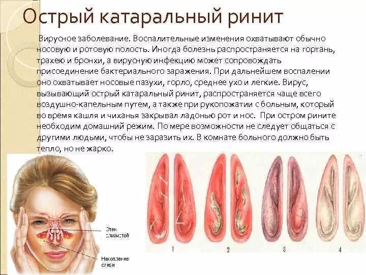 Катаральный ринит профилактика. Хронический катаральный ринит риноскопия. Риноскопия при остром рините. Острый ринит катаральный ринит.