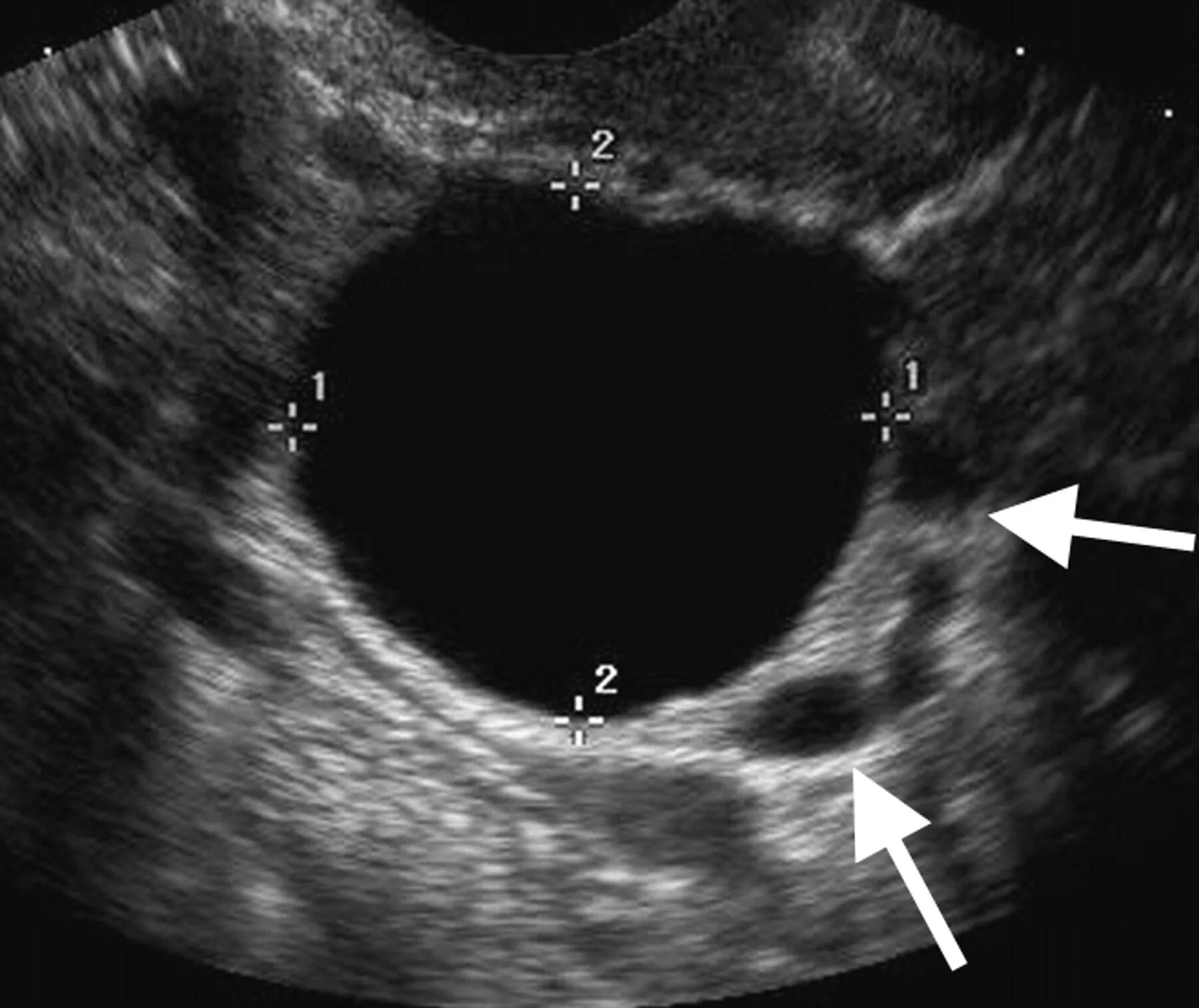 Фолликулярная киста яичника на УЗИ. Фолликулярные кисты яичников УЗИ. Ретенционные кисты яичников УЗИ. Фолликулярная киста на УЗИ. Киста яичника с перегородками