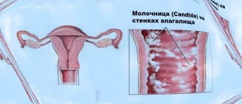 Клиническая молочница