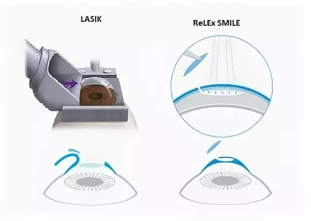 Коррекция зрения методом смайл. Лазерная коррекция RELEX smile. Лазерная коррекция зрения LASIK. Лазерная коррекция зрения ФРК.