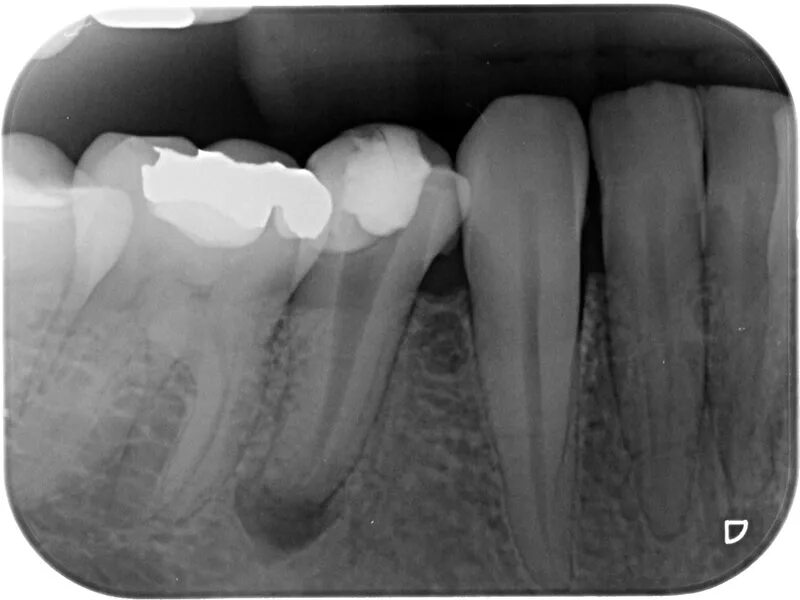 Воспаление канала зуба. Периодонтит зуба рентген. Периапикальный периодонтит. Хронический периодонтит рентген. Хронический гранулематозный апикальный периодонтит.