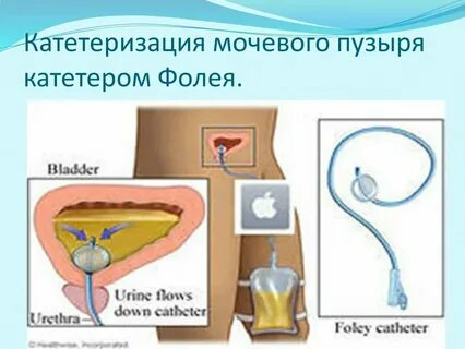 Постановка фолея алгоритм