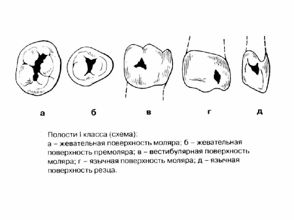 Классификация кариозных полостей по блэку. Препарирование 1 класса по блэку. кариозная полость 1 класса по блэку. препарирование кариеса 1 класса.