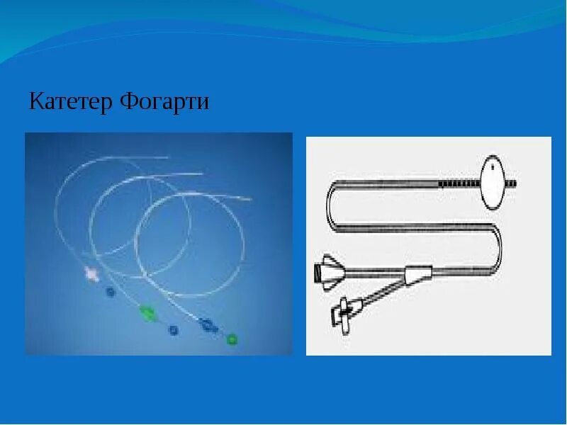 Катетер фогарти. Катетер Фогарти f 5. Катетер баллонный для тромбэктомии. Катетер Фогарти 3. Зонд «Фогарти» 3 f.