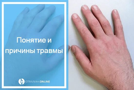 Как отличить гематому. Отличить перелом пальца от ушиба. отличие ушиба от перелома пальца. повреждение пальцев рук.