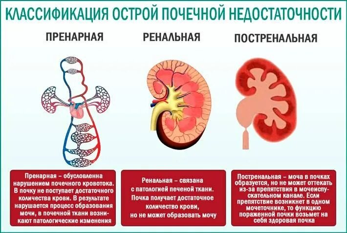 Поча ки. Острая и хроническая почечная недостаточность причины. Острая почечная недостатьс. Острая почечная недостаточность причины. Преренальная почечная недостаточность.