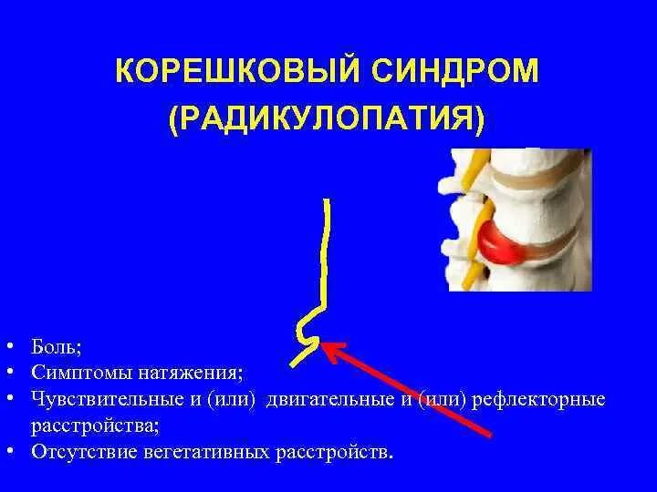 Как лечить корешковый синдром. Корешковый синдром л1. корешковый компрессионный синдром. радикулопатия l2 симптомы. что такое корешковый синдром позвоночника.