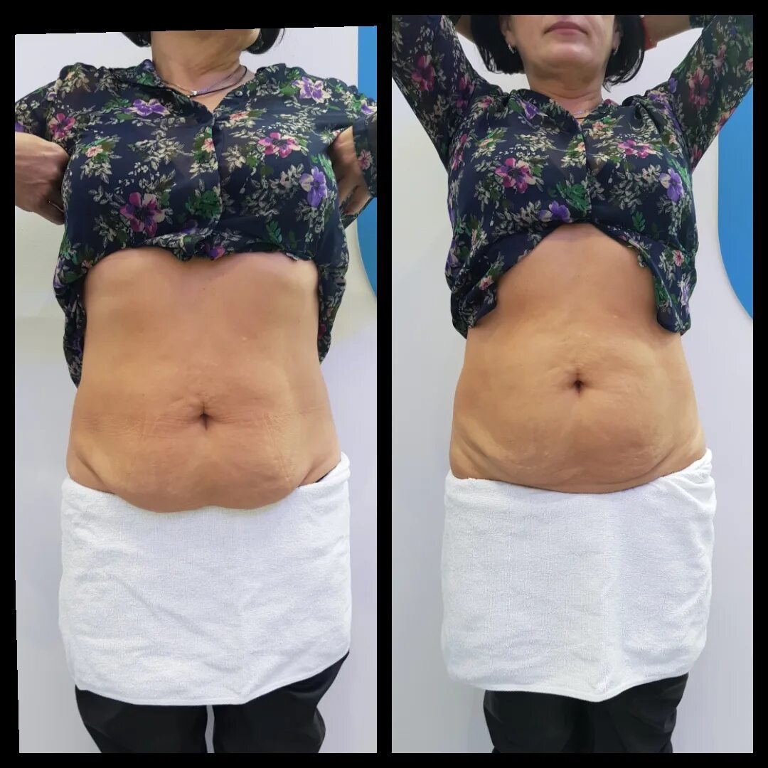 кавитация живота отзывы