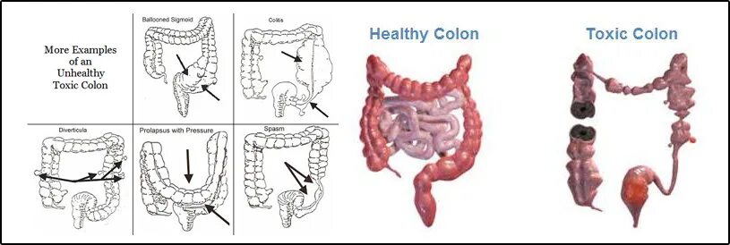 Colon Hydrotherapy. How to use Colon. Omni Colon. Colon перевод