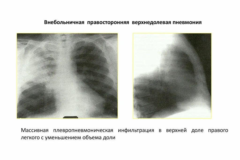 Долевая крупозная пневмония рентген. Правосторонняя нижнедолевая очаговая пневмония рентген. Правосторонняя очаговая пневмония рентген. Внебольничная очаговая пневмония рентген. Изменения в верхней доле легкого