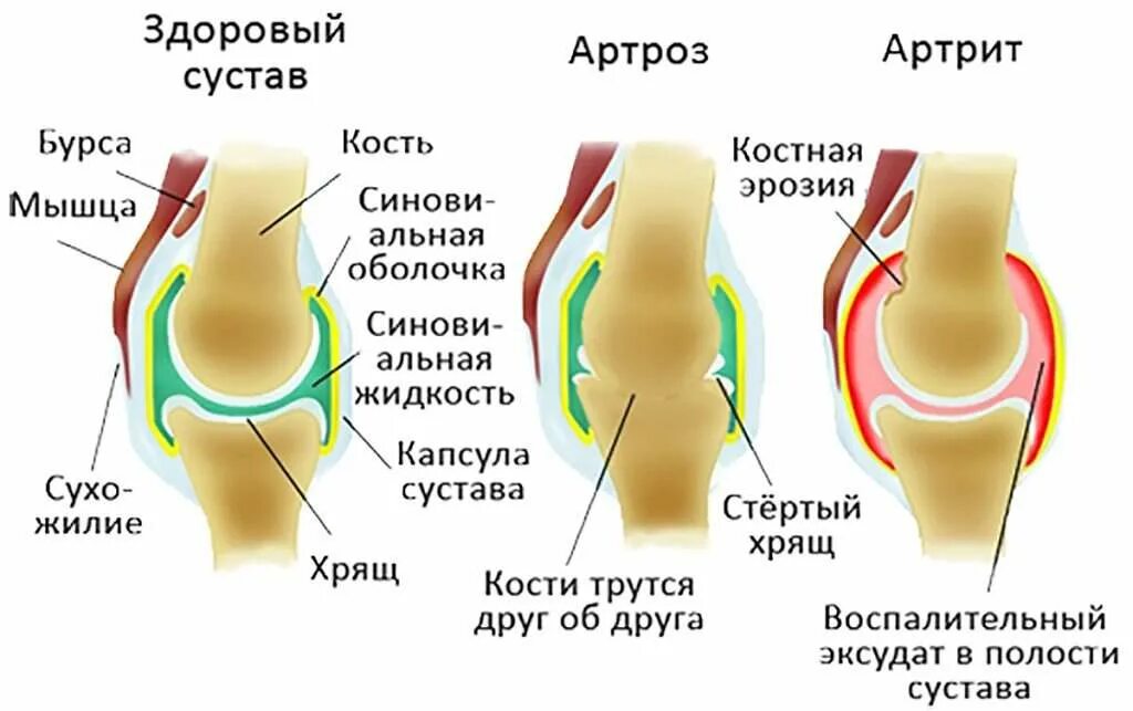 Артрит и артроз разница. Деформирующий артроз ревматоидный артрит таблица. Остеоартрит остеоартроз разница. Отличие артрита от артроза.