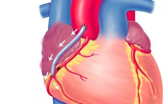 Шунтирование сосудов сердца. Аортокоронарное шунтирование сердца. Аорто-коронарное шунтирование. После коронарного шунтирования. Как делают коронарное шунтирование