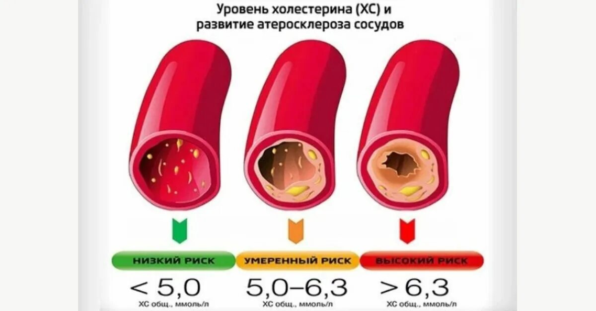 На уровень холестерина крови влияют. Холестерин. Высокий уровень холестерина. Уровень холестерина при атеросклерозе.