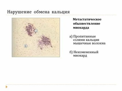 Нарушения кальция