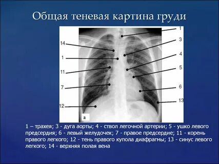 Легочная дуга