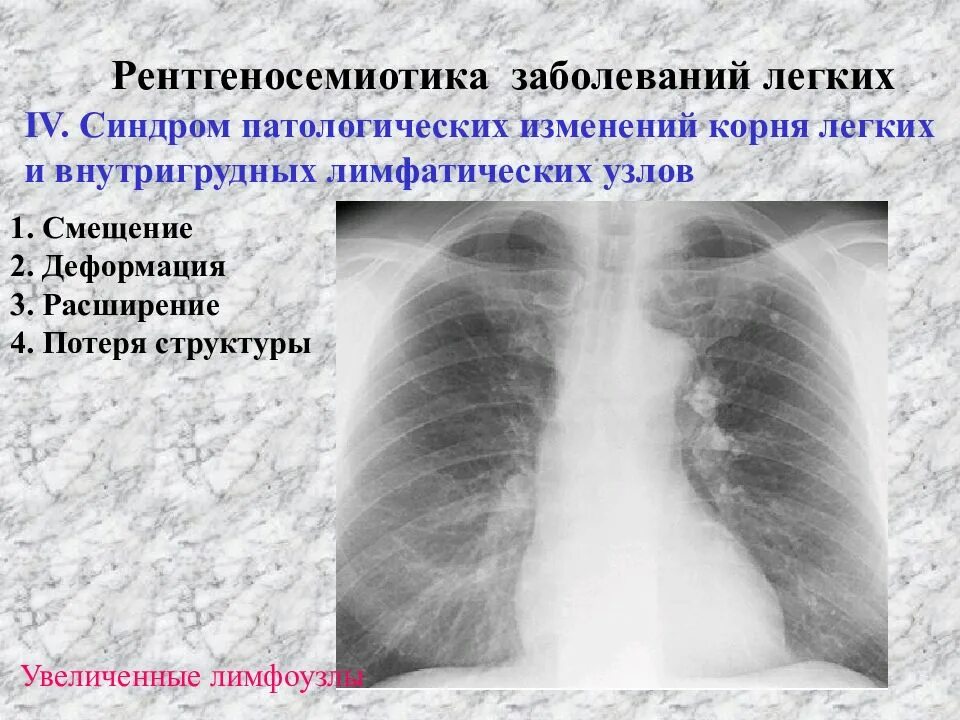 Причины изменений в легких. Синдром патологии легочного рисунка. Заболевания корня легкого. Корни лёгких на рентгенограмме.