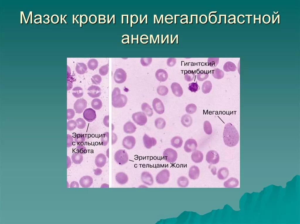 Мазок крови при выявлении патологии что это. В12 мегалобластная анемия. Мегалобластная анемия мазок крови. Мегалобластная анемия костный мозг. В12 дефицитная анемия мазок.