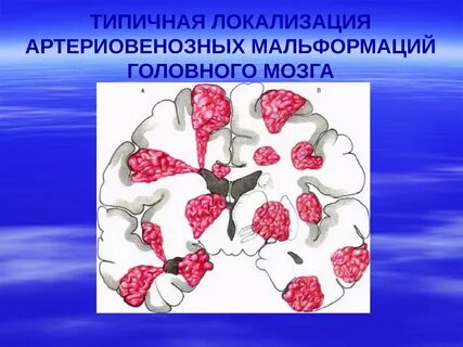 Типичная локализация